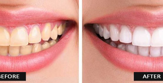 Teeth Whitening Results Before After