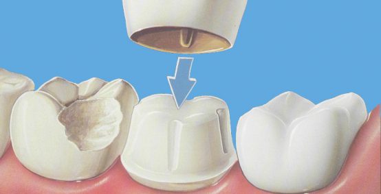 Dental Crowns and Prosthetics
