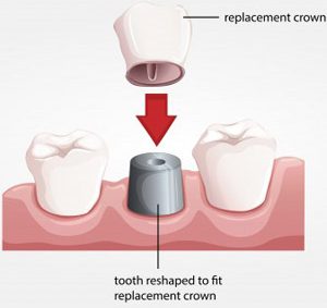 Dental crowns