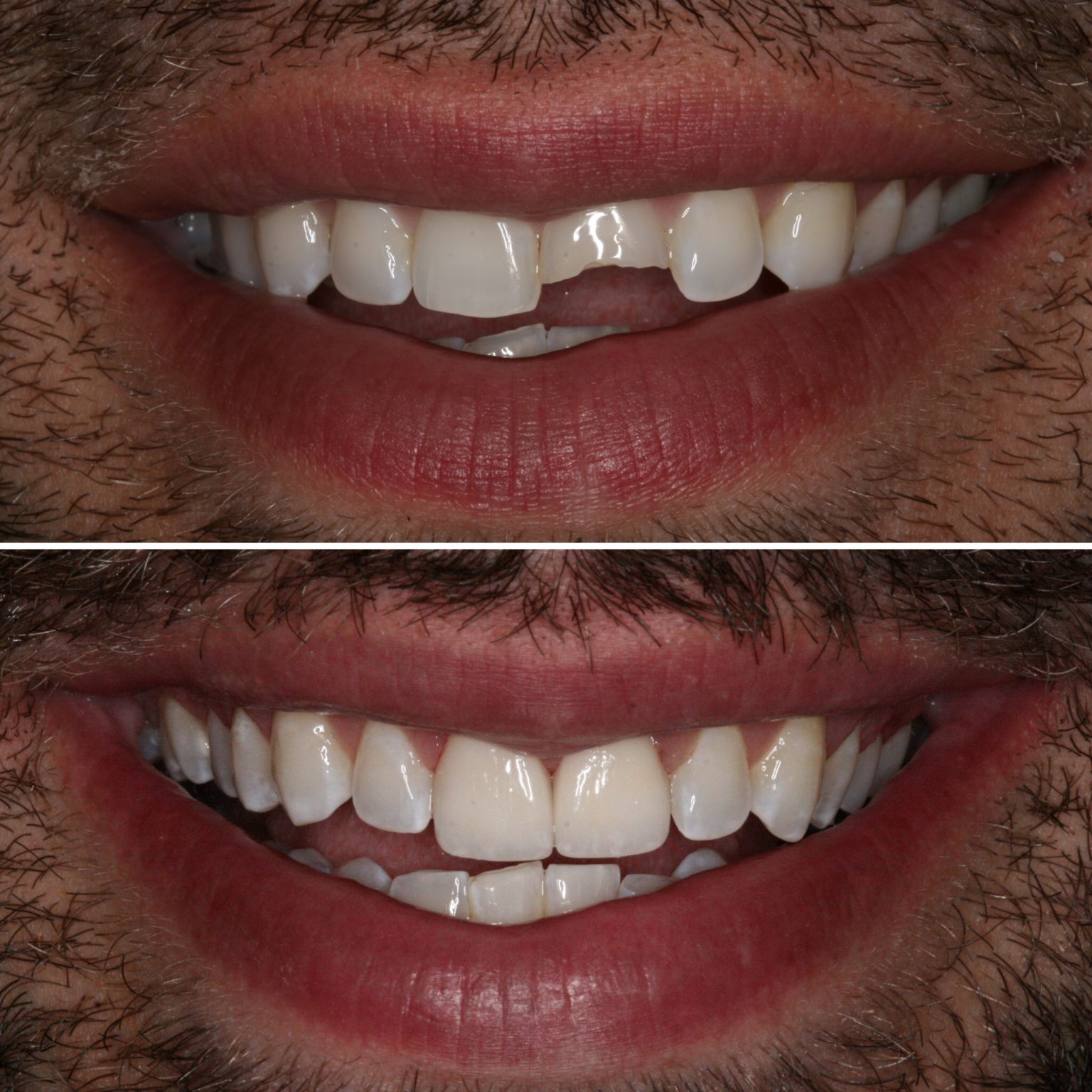 Dental Crown Before and After