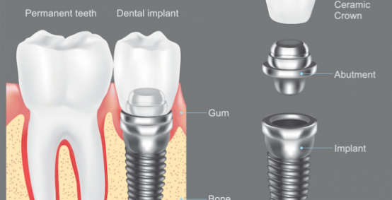 Dental Implants in Ballantyne NC